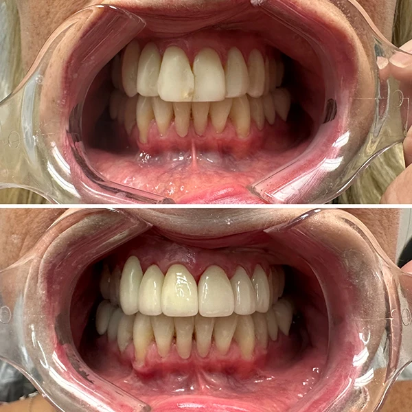 Teeth Whitening