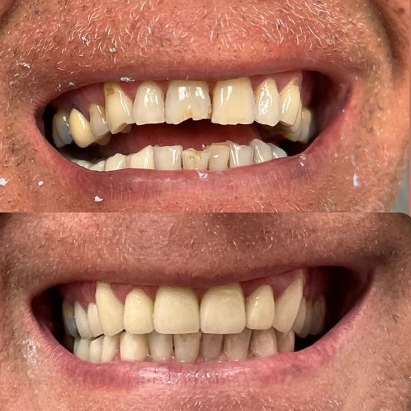 Denture Stabilization