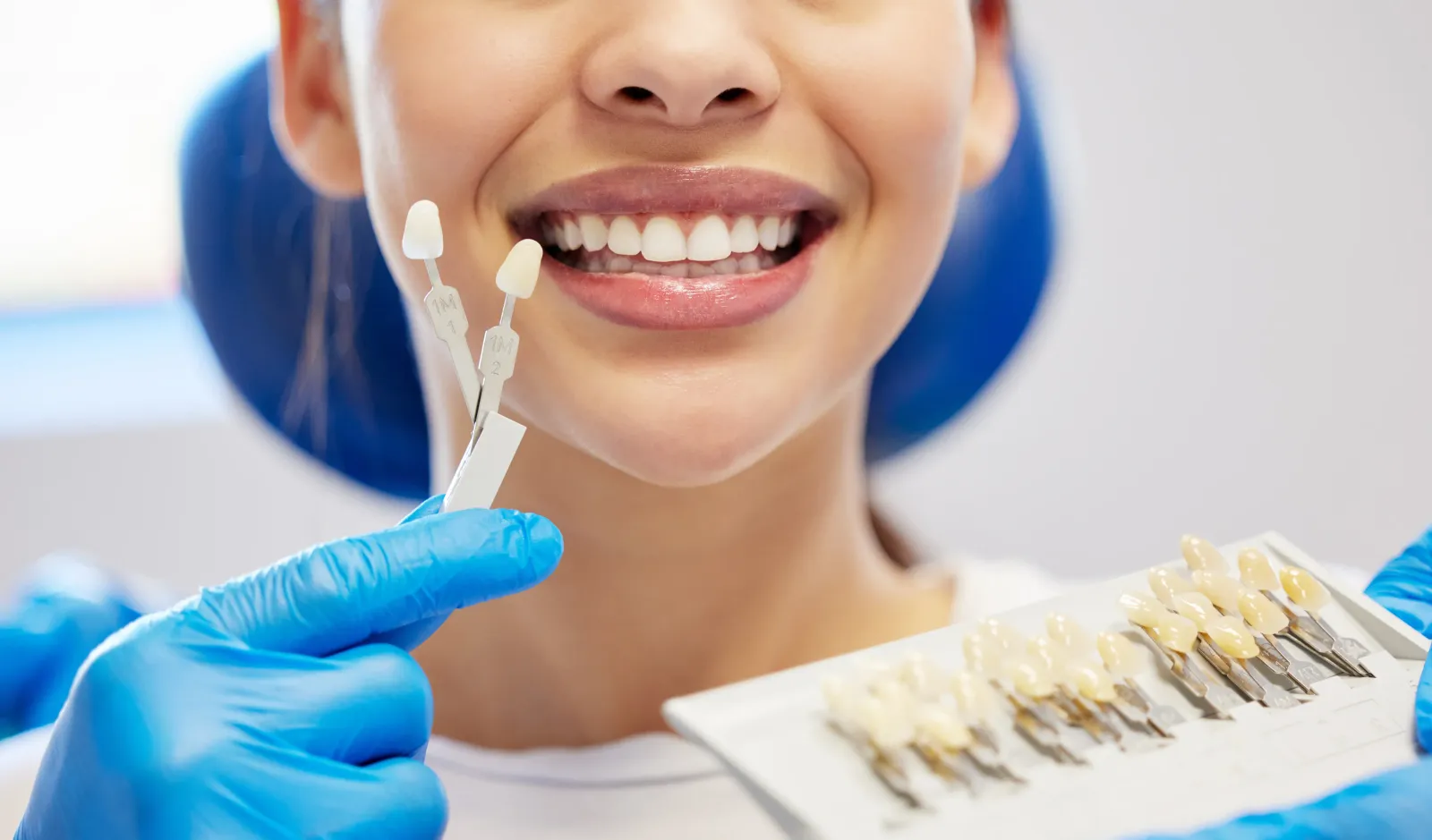 Veneers