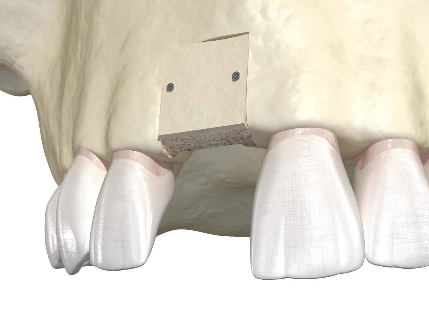 Wisdom teeth removal at Tampa Dental Studio