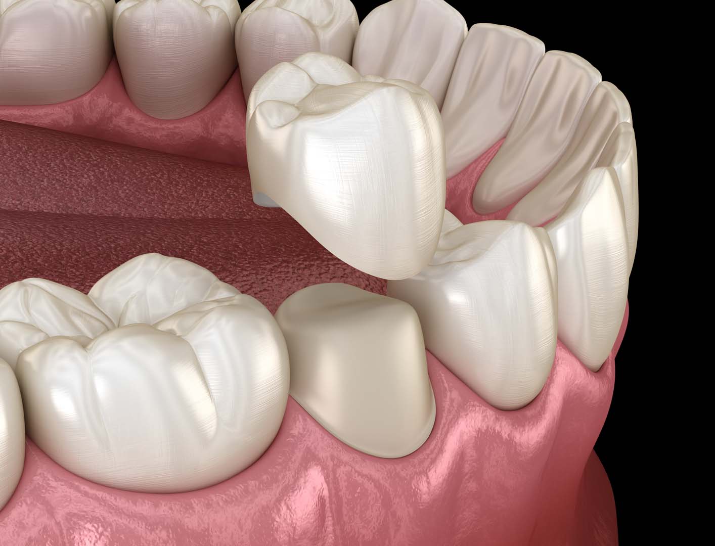 Custom dental crown restoration at Tampa Dental Studio
