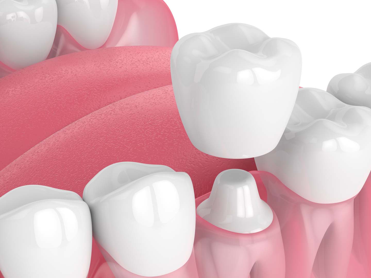 Dental bridges treatment at Tampa Dental Studio in Tampa, FL