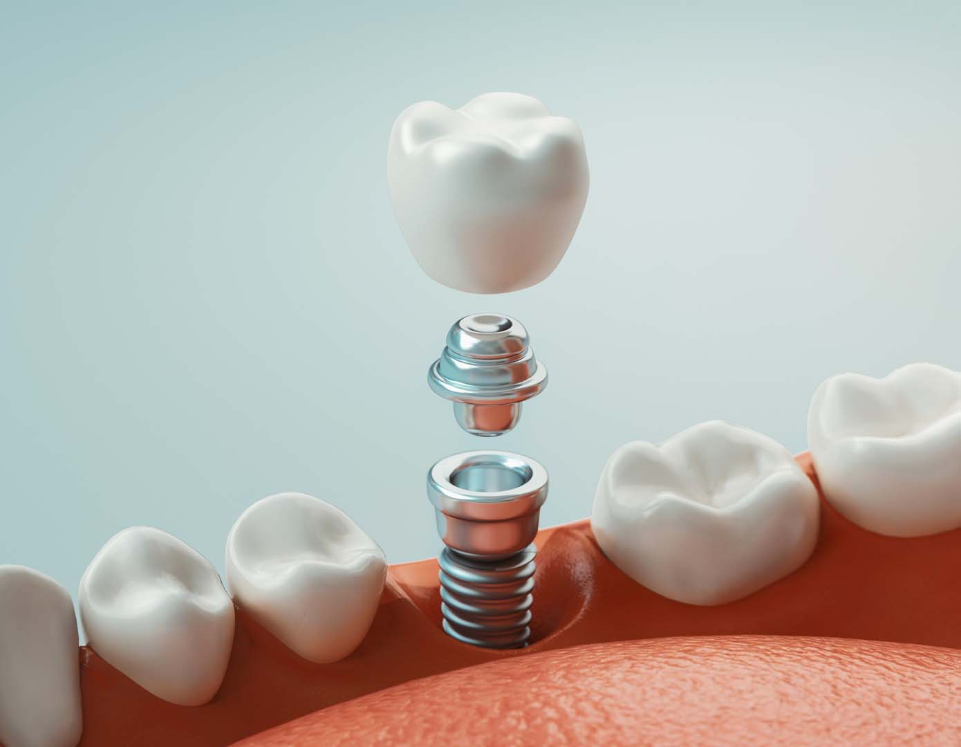 Denture stabilization at Tampa Dental Studio