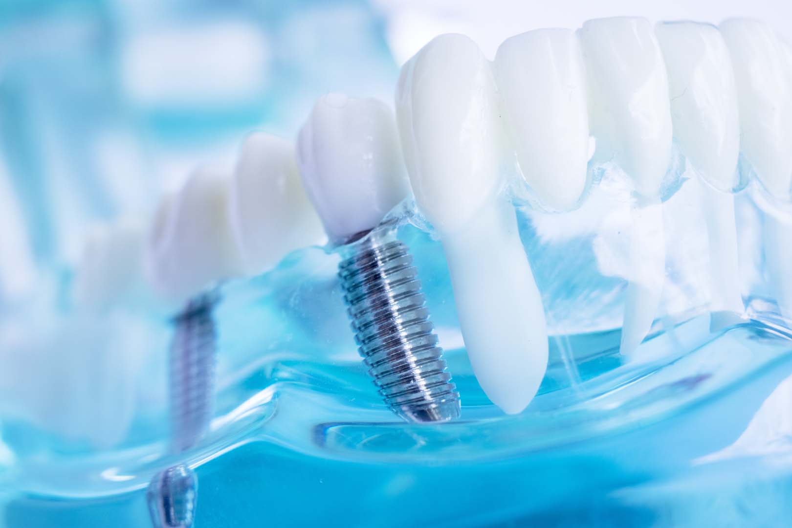 Dental implants