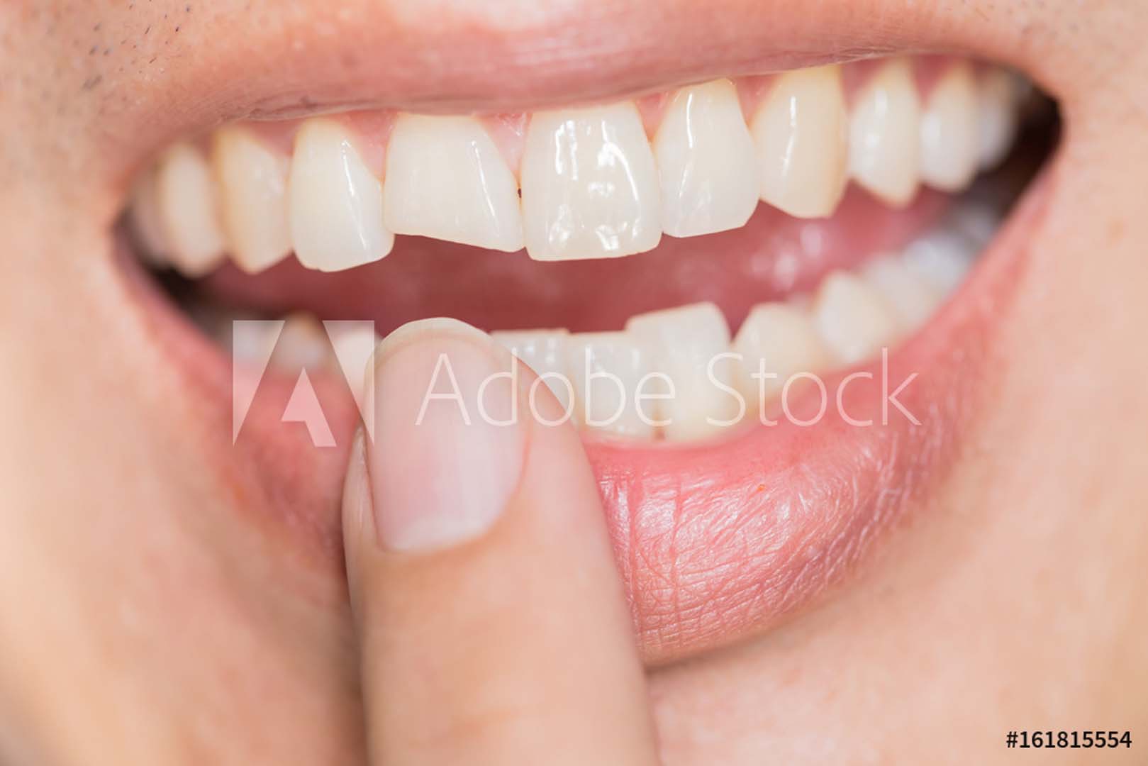 Dental fillings treatment at Tampa Dental Studio in Tampa, FL