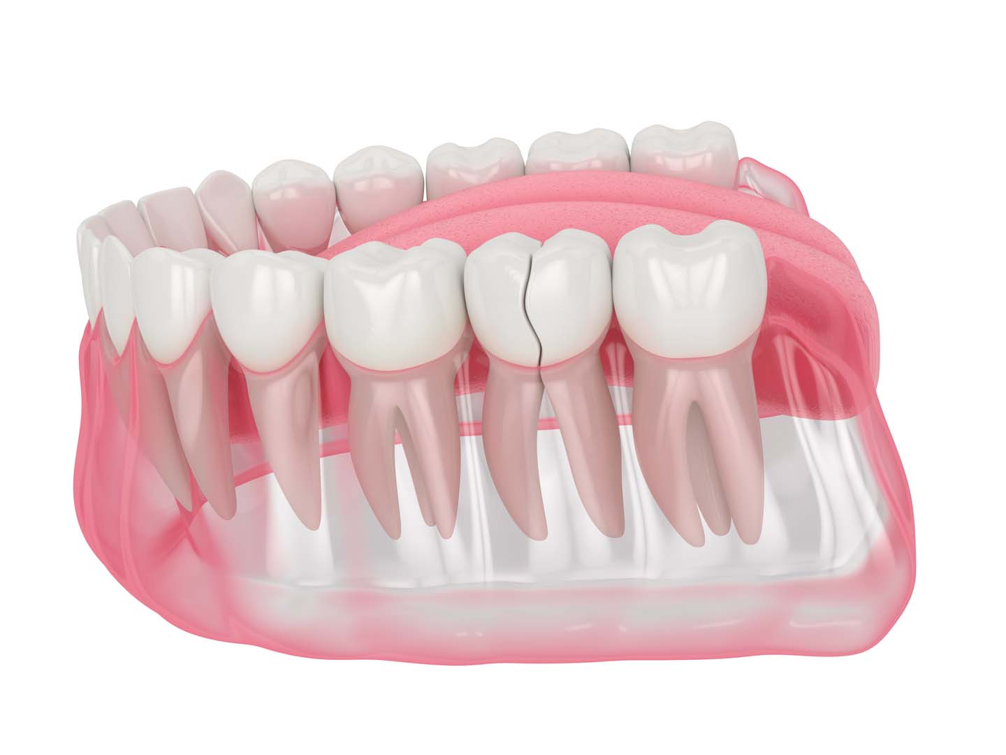 Emergency dentistry at Tampa Dental Studio in Tampa, FL