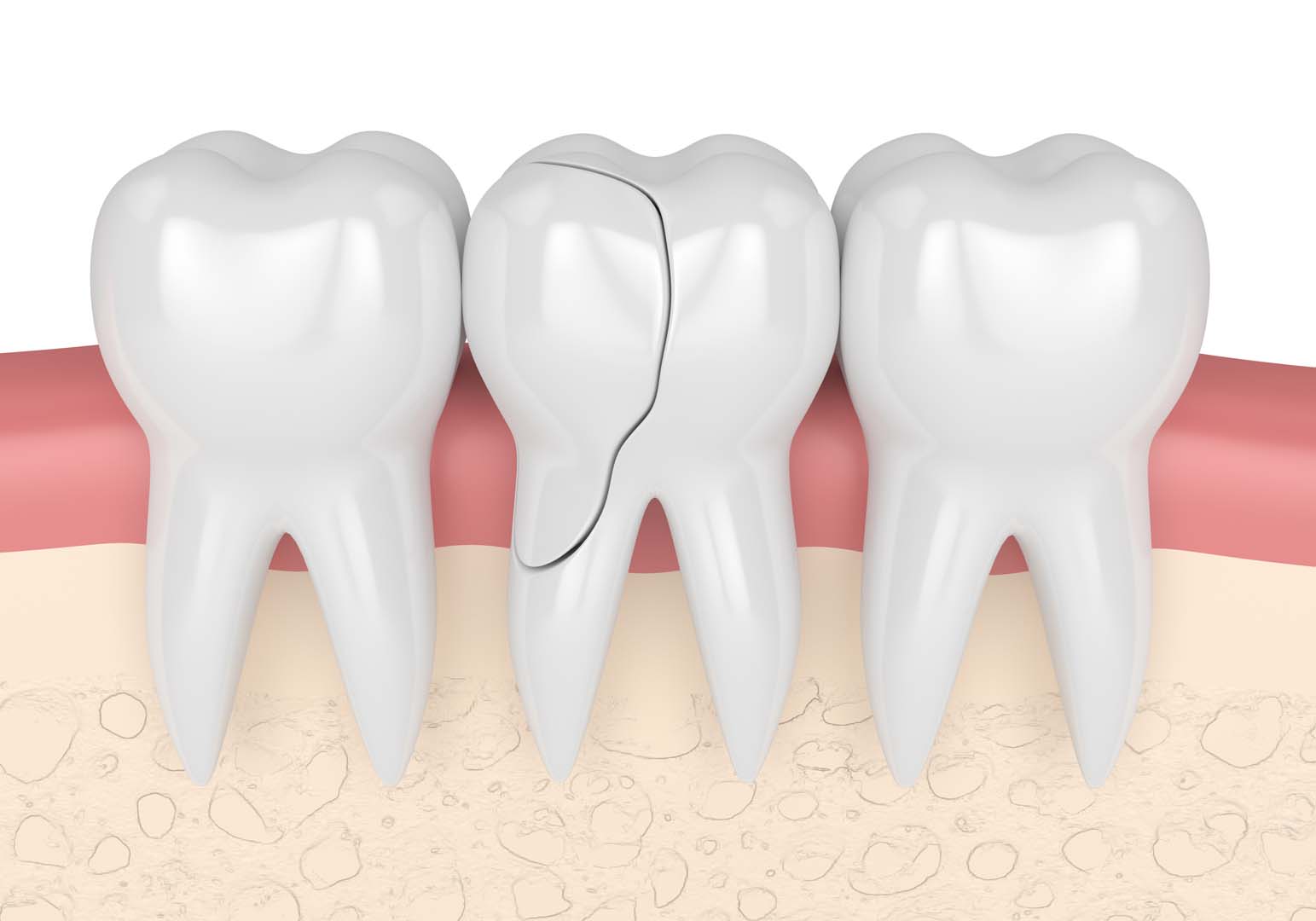 What is a dental filling — Tampa Dental Studio