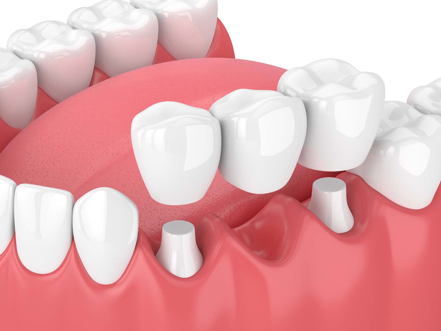 Dental crowns at Tampa Dental Studio