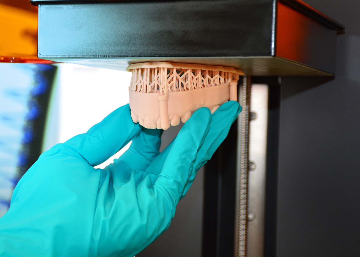 Implant-anchored denture stabilization