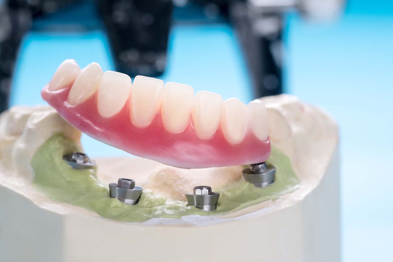 What are dentures