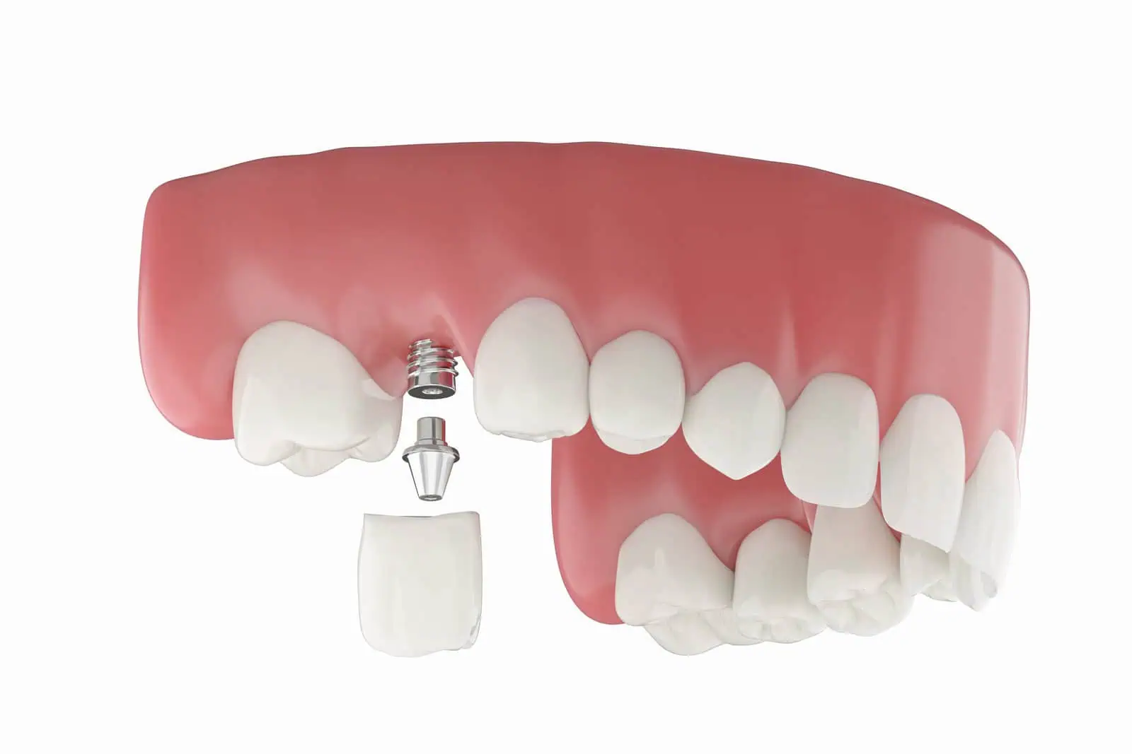 3D CT scan used for dental implant planning