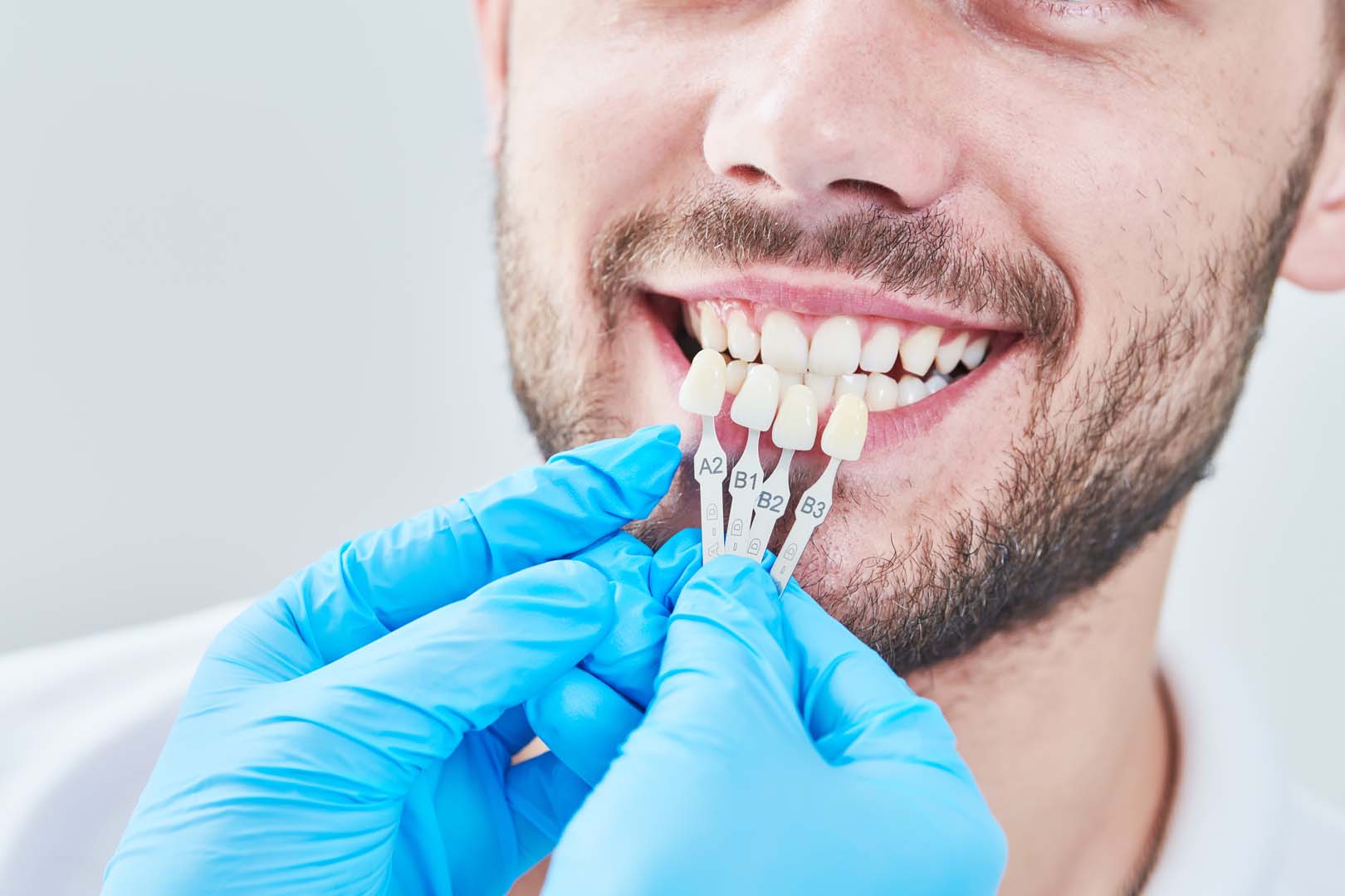Custom veneers at Tampa Dental Studio