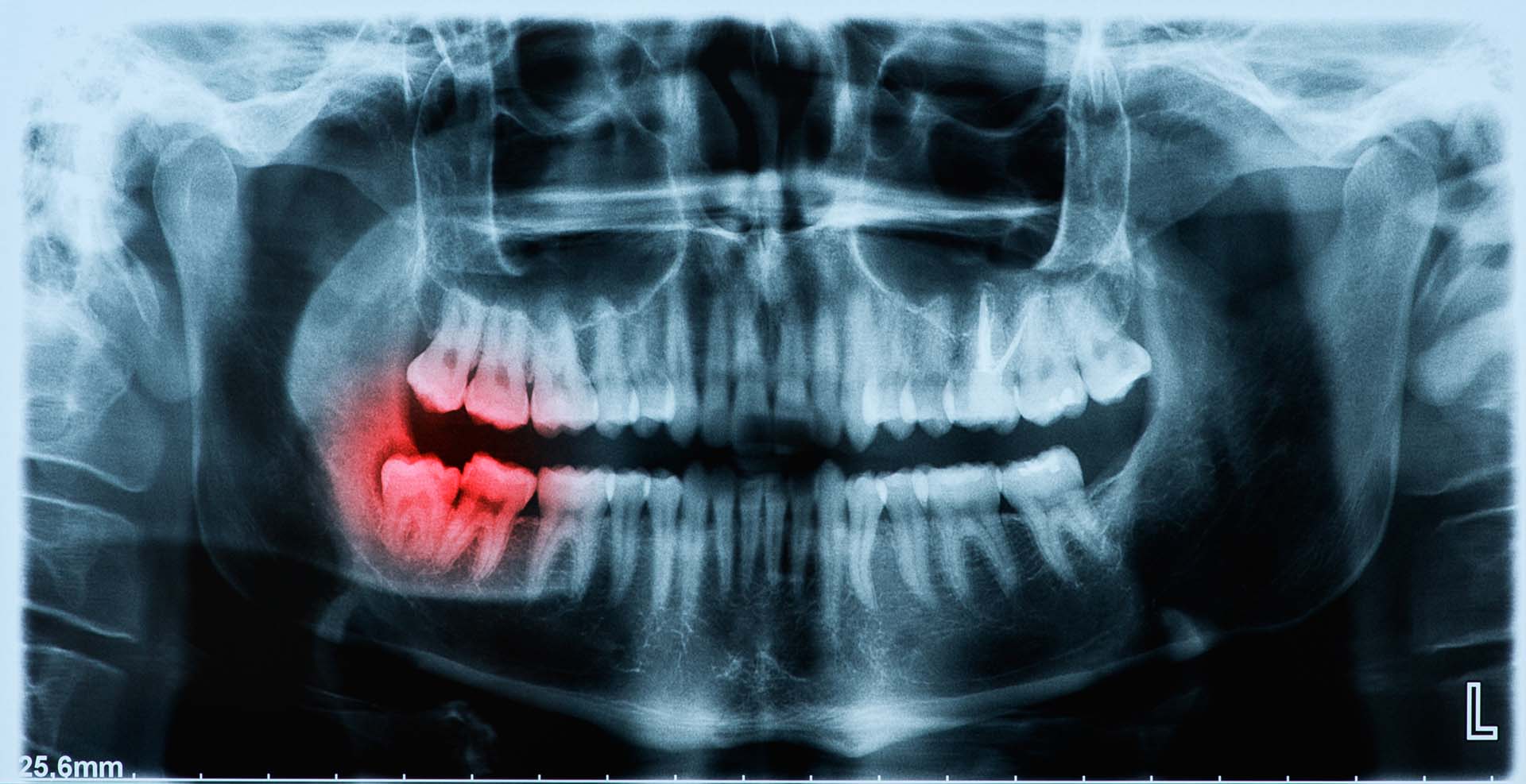 Dental emergencies
