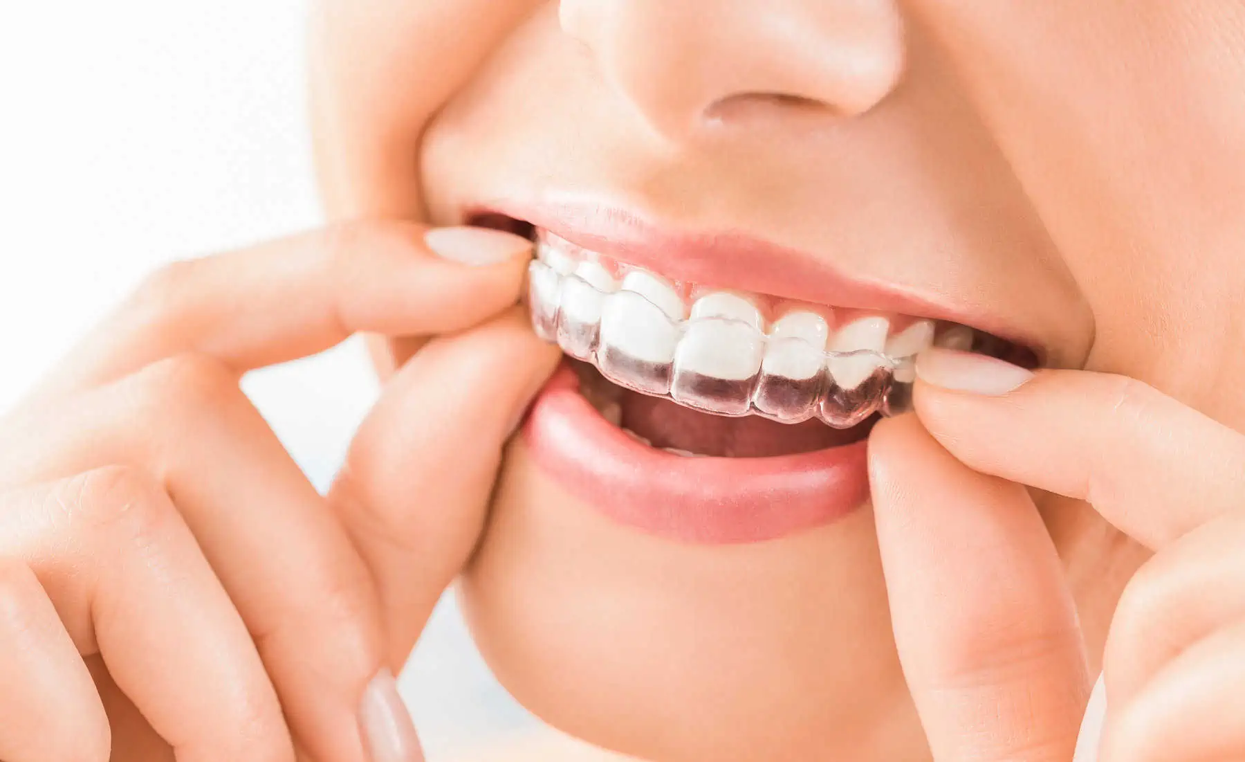 What Is an Invisalign Retainer and Why It Matters After Treatment