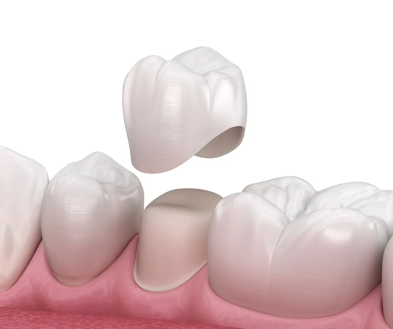 Temporary Crown Came Off: What to Do Next